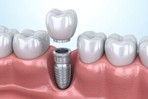 Picture of Dental Implants