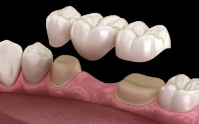 Dental Crowns and Bridges: Restoring Your Smile’s Strength and Beauty