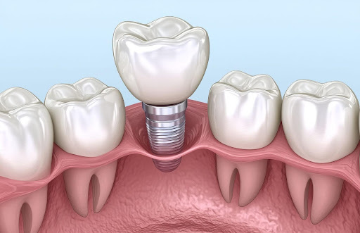 Understanding Teeth-in-a-Day Implants